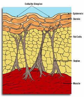 cellulite